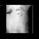Small bowel ileus: X-ray - Plain radiograph